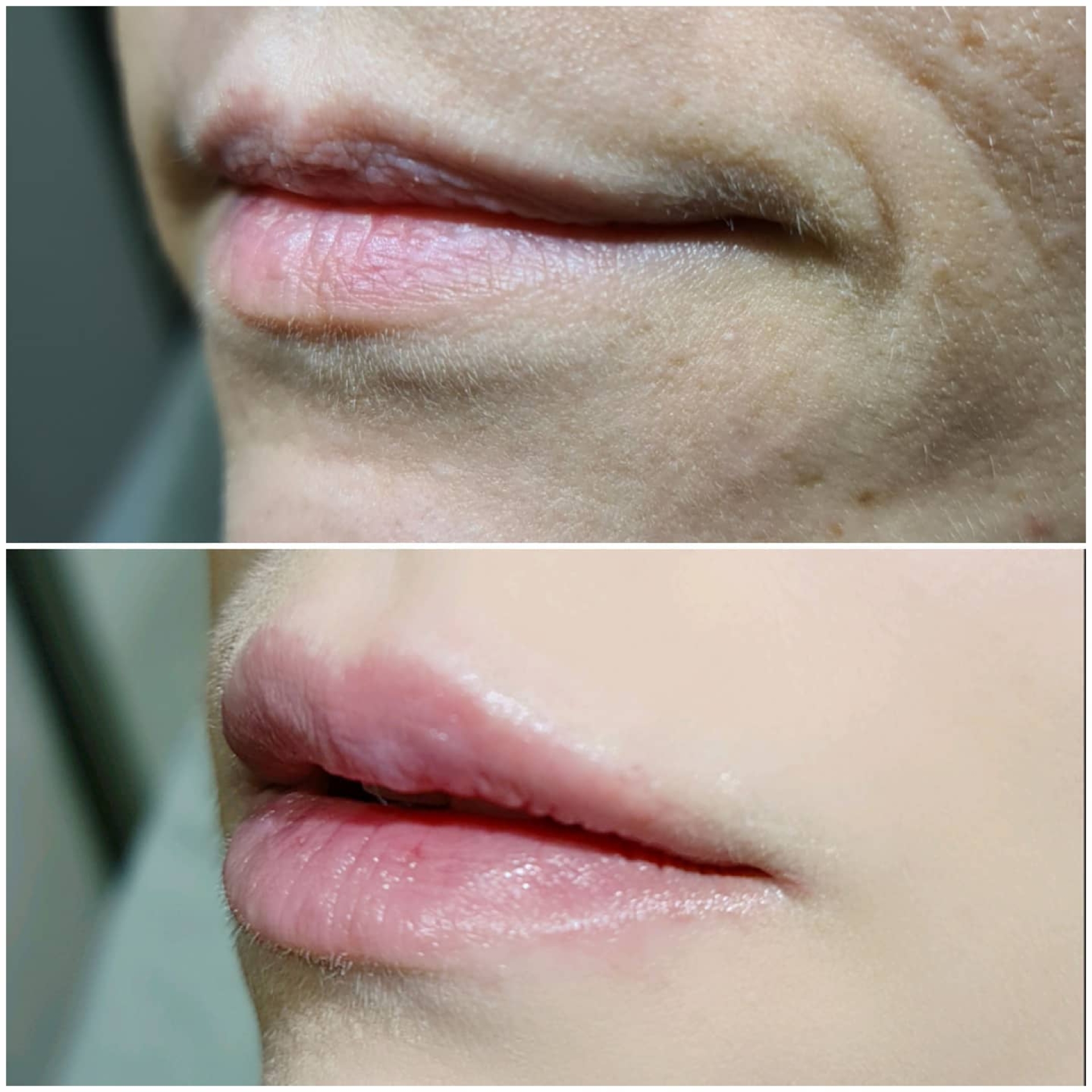 LIP FILLERS