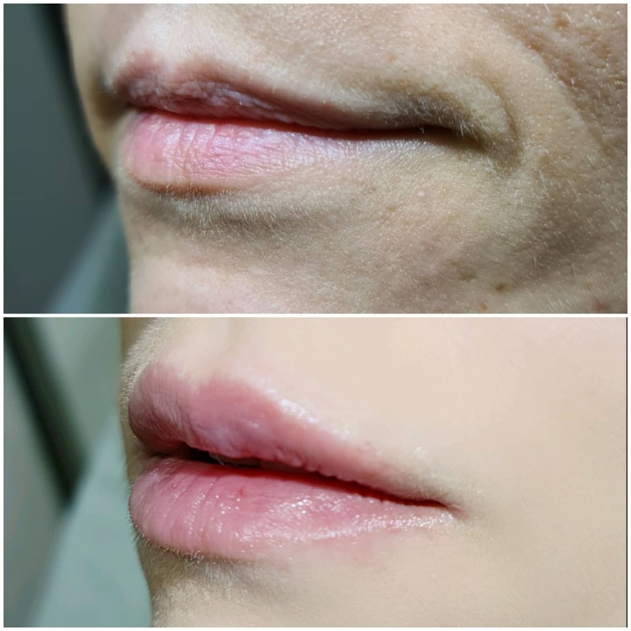 LIP FILLERS